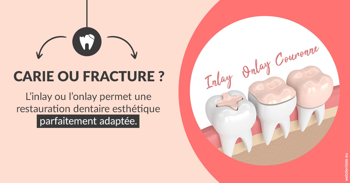 https://dr-labret-olivier.chirurgiens-dentistes.fr/T2 2023 - Carie ou fracture 2