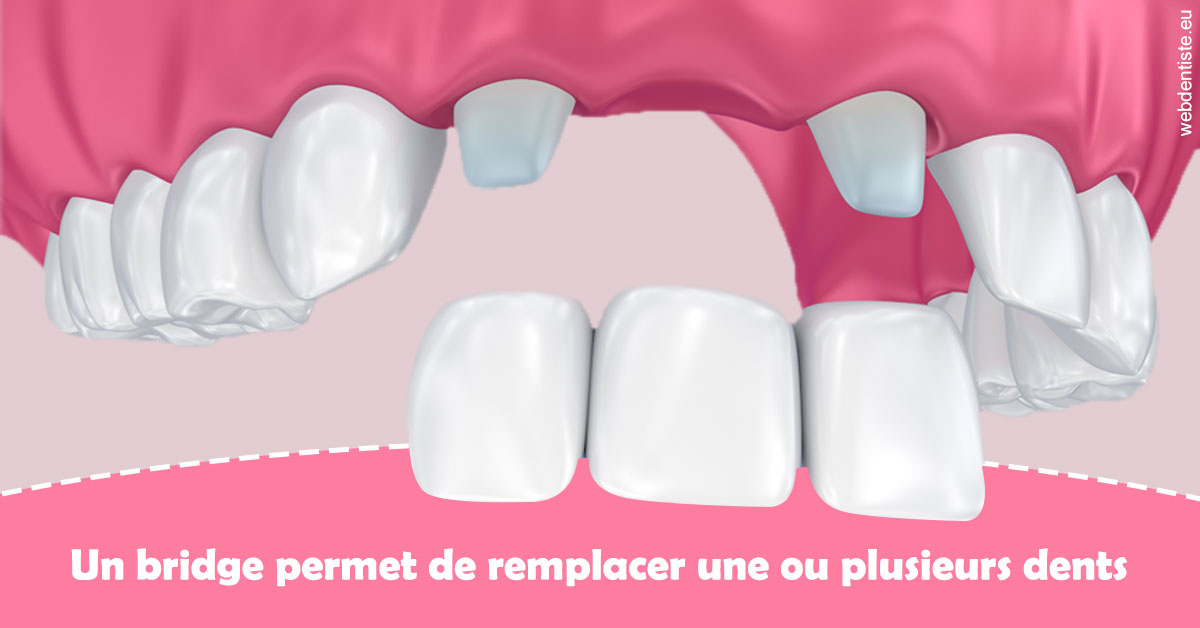 https://dr-labret-olivier.chirurgiens-dentistes.fr/Bridge remplacer dents 2