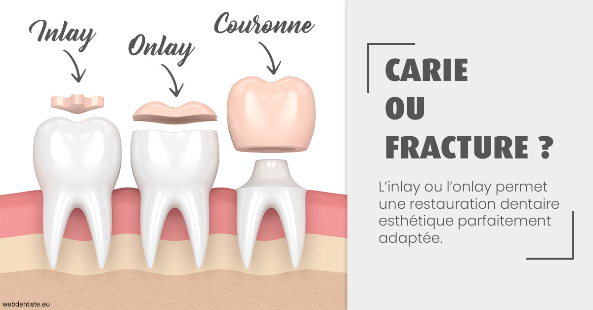 https://dr-labret-olivier.chirurgiens-dentistes.fr/T2 2023 - Carie ou fracture 1