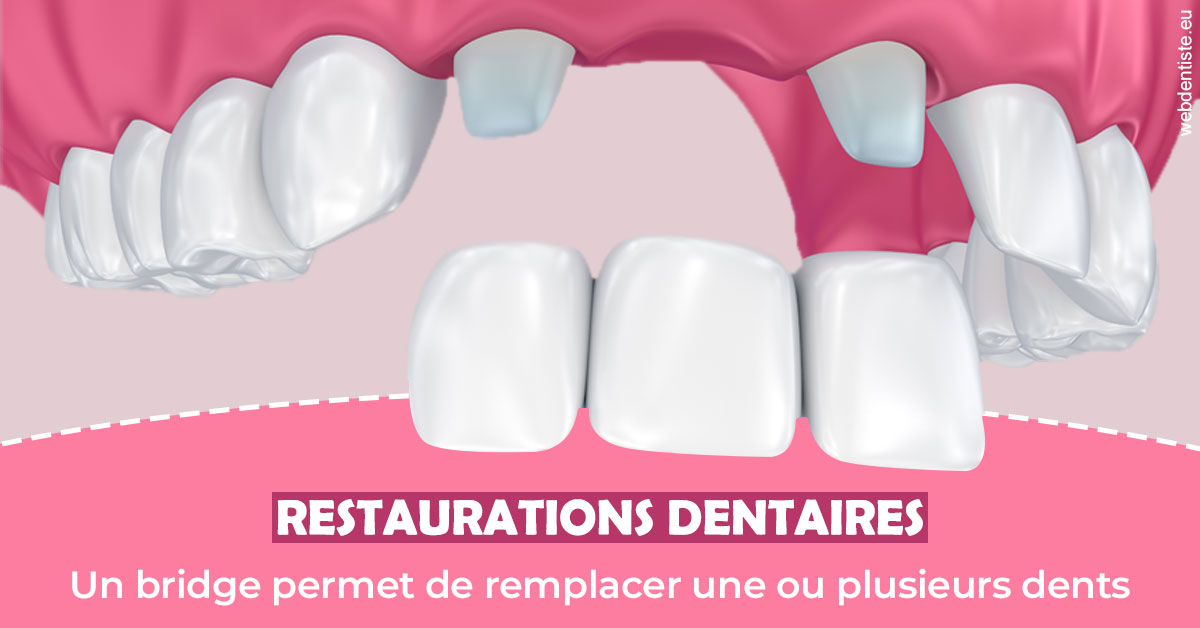 https://dr-labret-olivier.chirurgiens-dentistes.fr/Bridge remplacer dents 2