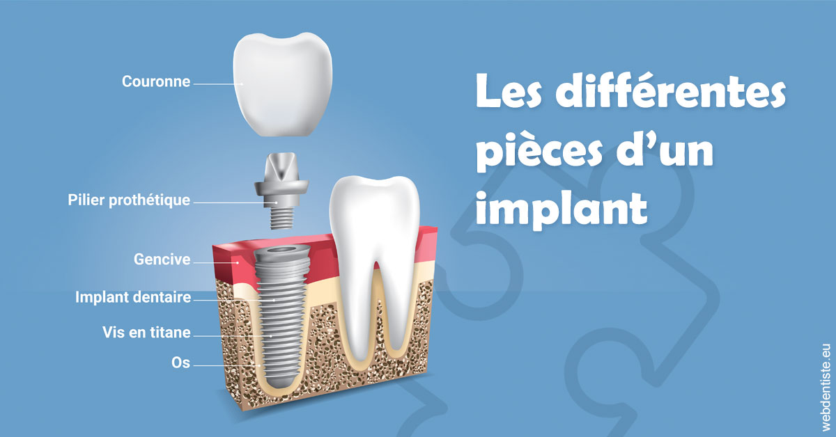 https://dr-labret-olivier.chirurgiens-dentistes.fr/Les différentes pièces d’un implant 1